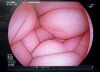 FUJIFILM EG-580NW Endoscope