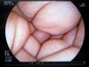 FUJIFILM EG-L590WR Endoscope