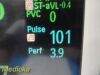 PHILIPS Intellivue MP20,Ref M8001A W/ M3001A MMS Module & Leads ~ Monitor