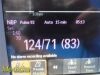 PHILIPS 2012  Intellivue MP30,W/ 3001A MMS Module/Leads~ Anesthesia Monitor