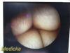 ARTHREX AR-3350-4070H Arthrex AR-3350-4070H Hip Arthroscope