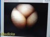 ARTHREX AR-3355-4070H C-Mount Hip HD Arthroscope | 70° | 3.5 x 204mm
