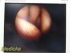 ARTHREX AR-3355-4070H C-Mount Hip HD Arthroscope | 70° | 3.5 x 204mm