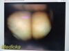 Guidant Ref 11333 Rigid Telescope 5mm x 70º | Vascular Ligation Scope