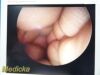 STRYKER 10mm x 0° Ref 331-010-045 ; WL=270mm ~  Operating Laparoscope