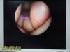 ARTHREX AR-3355-4030H C-Mount Hip ; HD | 30° | 3.5 x 202mm ~ Arthroscope