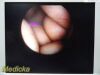 ARTHREX AR-3355-4030H C-Mount Hip ; HD | 30° | 3.5 x 202mm ~ Arthroscope