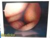 SMITH & NEPHEW 4131 Rigid Telescope | 2.7mm x 30° Arthroscope
