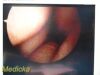 SMITH & NEPHEW 4131 Rigid Telescope | 2.7mm x 30° Arthroscope