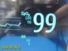 PHILIPS 2010  Intellivue MP30,W/ MMS Module & NEW Leads ~ Patient Monitor