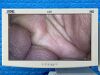 KARL STORZ Spies Tower Laparoscope