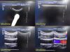 PHILIPS iU22 Diag Ultrasound W/ L17-5, L15-7io, C8-5 Probes &Foot Control