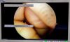 SMITH & NEPHEW 72202959 Arthroscope
