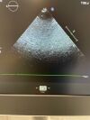 PHILIPS X5-1 Ultrasound Transducer