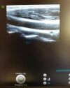 GE ML6-15-D Ultrasound Transducer