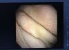 OLYMPUS BF-1T160 Endoscope