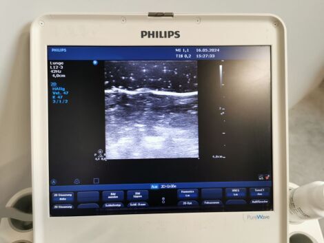 PHILIPS CX-50 Portable Ultrasound