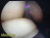 OLYMPUS LF-GP Flexible Tracheal Intubation