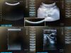 SIEMENS ACUSON Freestyle Ultrasound - OB / GYN - Vascular