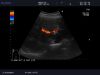 ALOKA UST-9115 Ultrasound Transducer