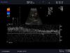 ALOKA UST-9115 Ultrasound Transducer