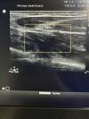 PHILIPS L12-5 Ultrasound Transducer