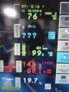 SPACELABS 91370 Ultraview SL Patient Monitor