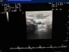 KONTRON LA523K Ultrasound Transducer