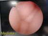 RICHARD WOLF 8935.431 5mm 0° Degree Panoview Lumina SL Rigid Telescope