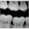 SCHICK CDR Elite Size 1 Dental Sensors