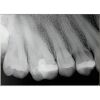 SCHICK CDR Elite Size 1 Dental Sensors