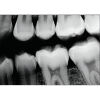 SCHICK CDR Elite Size 2 Dental Sensors