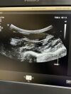PHILIPS C9-2 989605391091 Ultrasound Transducer