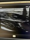 PHILIPS L12-3 Ultrasound Transducer