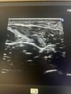 PHILIPS MEDICAL l15-7io Hockey Stick Ultrasound Probe for Epiq