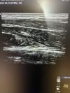 GE ML6-15-D Ultrasound Transducer
