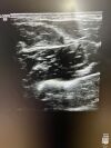 GE 9L-D Ultrasound Transducer