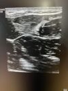 GE L8-18i-D Ultrasound Transducer