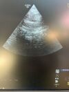 GE 6Tc Ultrasound Transducer