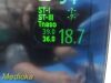PHILIPS Intellivue X2 M3002A Ref 865039 Transport Monitor
