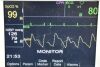 ZOLL R Series ALS Monitor W/ NIBP, CO2, ECG, Masimo SPO2, MFC, Pacing, & Printer Defibrillator