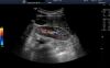 GE C1-5-D Ultrasound Transducer