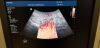 PHILIPS V6-2 Convex 4D Ultrasound Transducer