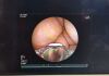 FUJINON EB-530 US linear ultrasonic broncho scope video endoscope EBUS Endoscope Bronchoscope