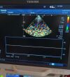 TOSHIBA PST-25BT Ultrasound Transducer