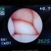 OLYMPUS MAF-TM Endoscope