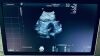 GE VOLUSON E10 Ultrasound - OB / GYN
