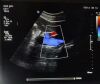 PHILIPS Probe PHILIPS EPIQ7 New Original Convex Array Ultrasound Probe C5-1