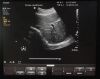 PHILIPS Probe PHILIPS Clearvue Original Convex Array Ultrasound Probe C5-2