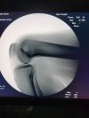 SHIMADZU WHA-200 OPESCOPE PLENO C-Arm